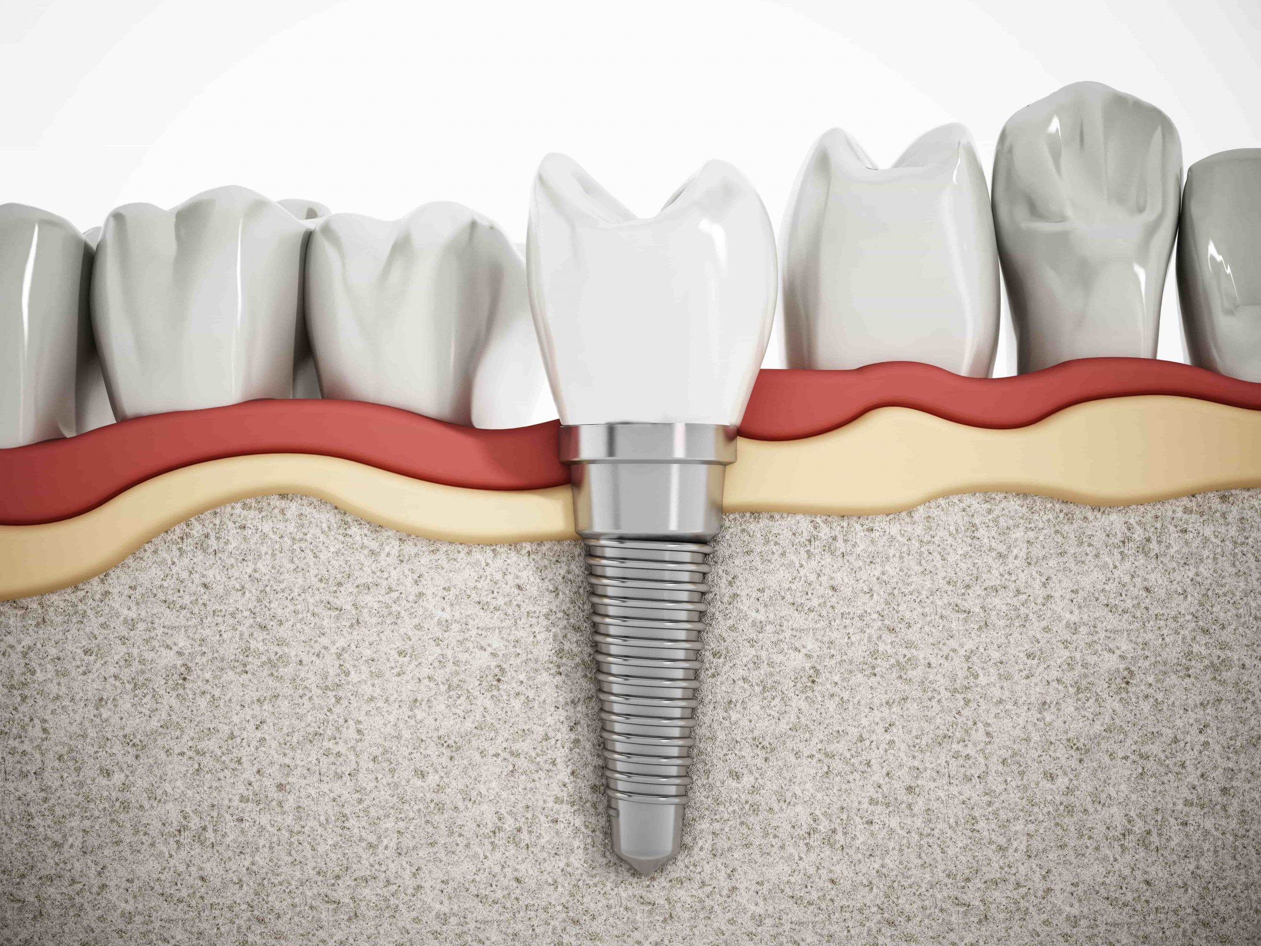 Why Dental Implants Are Popular For Tooth Replacement